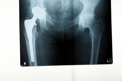 Tens of Thousands of Hip Replacement Lawsuits Expected to Settle